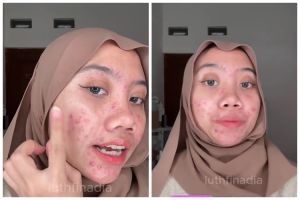 Dikira jerawatan selama 9 tahun, cewek ini bagikan kisahnya yang ternyata alami rosacea
