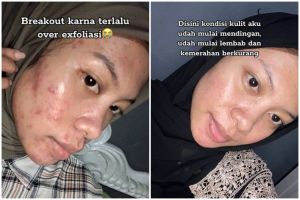 Cewek ini alami breakout di wajahnya efek over eksfoliasi, ini cara merawat dan menyembuhkannya