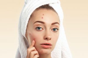 [KUIS] Acne fighters merapat! Cara kamu menangani jerawat sesuai jenisnya sudah tepat belum sih?