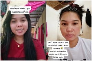 Wajah cewek ini jadi penuh flek hitam akibat gonta-ganti skincare, potret before-afternya bikin nyesek