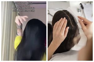 Cara atasi ketombe ini cuma pakai kombinasi sampo dan 1 bahan dapur, rambut auto bersih & lembut