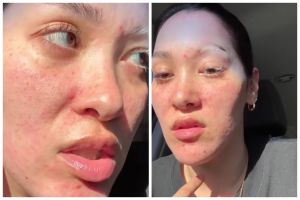 Kisah wanita alami ruam usai pakai skincare dengan kandungan lactid acid, efeknya muncul usai 20 jam
