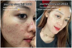 Kisah cewek sembuh dari jerawat hormonal ini penuh perjuangan, potret before afternya bikin takjub