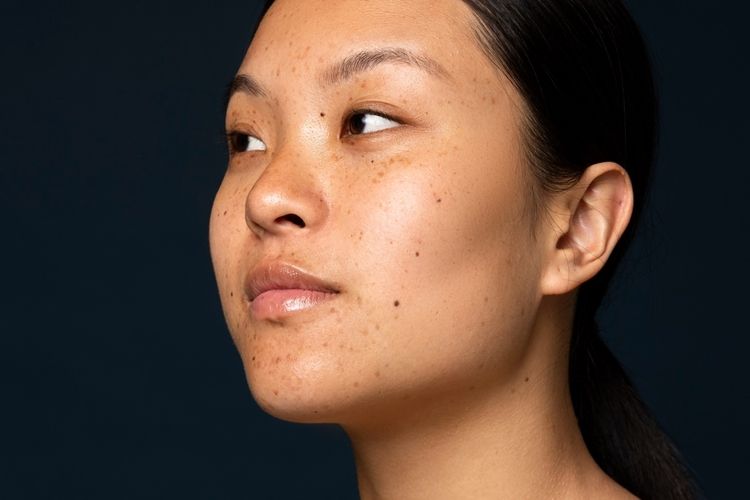 [KUIS] Serum untuk hilangkan hiperpigmentasi berdasarkan penyebabnya, cek di sini untuk hasil optimal