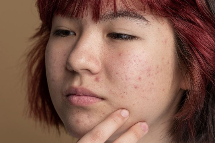 [KUIS] Acne fighters pasti paham, uji pengetahuanmu soal cara mengatasi bekas jerawat sesuai jenisnya