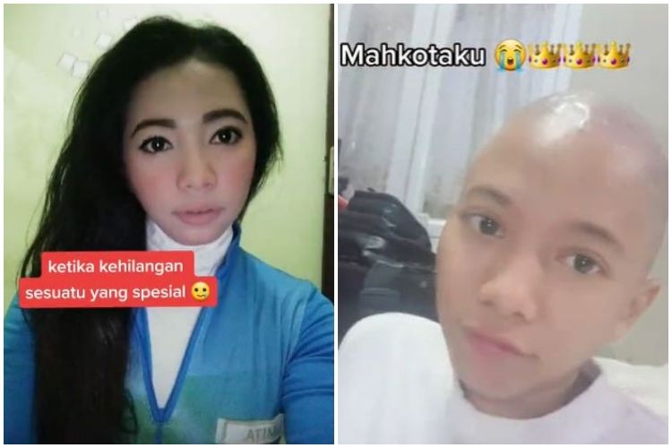 Rambut cewek ini terpaksa dipotong botak akibat ketombe, ini kisahnya yang bikin nyesek