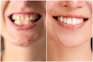 Buah kaya vitamin C ini bisa kikis noda kuning pada gigi, cara mengolahnya tak sampai 5 menit