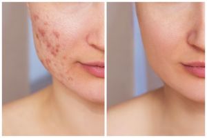 9 Rekomendasi skincare The Originote untuk kulit berjerawat, ampuh kontrol minyak di wajah