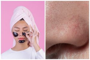 [KUIS] Cari tahu apakah cara menghilangkan komedo kamu sudah tepat atau belum lewat pertanyaan ini