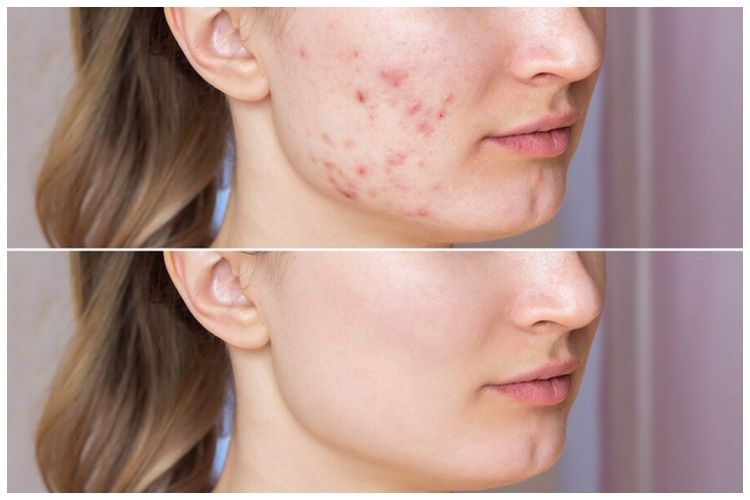 11 Rekomendasi skincare menghilangkan beruntusan di bawah Rp 150 ribu ini bikin wajah mulus kembali