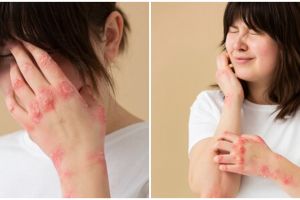 Wanita lebih rentan alami cacar api, kenali penyebab, gejala, dan cara pencegahannya