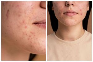 9 Rekomendasi skincare yang mengandung salicylic acid ini bantu hempaskan jerawat