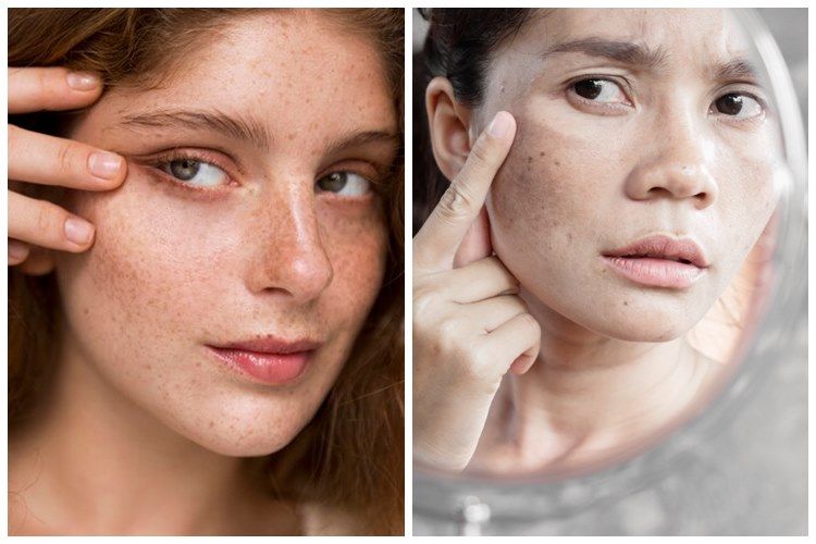 [KUIS] Cari tahu jenis flek hitam yang ada di wajahmu lewat pertanyaan singkat ini