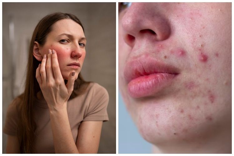 Perbedaan ciri-ciri skincare tidak cocok dan purging, pahami agar kulit tak berisiko iritasi
