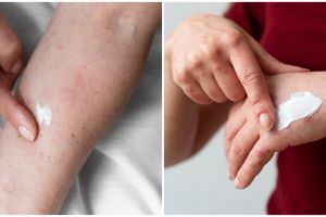 Hati-hati bertukar pakaian ke orang lain, kenali penyakit kurap, gejala, penyebab, dan cara mengatasi