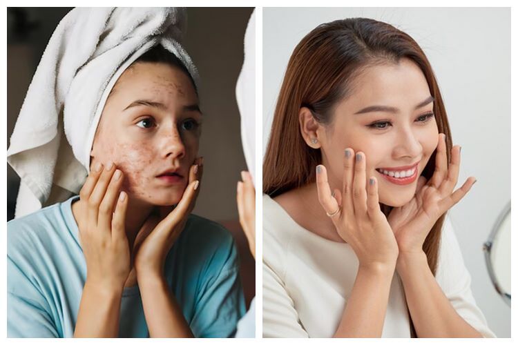 7 Perbedaan kandungan skincare salicylic acid dan hyaluronic acid, sama-sama bisa atasi jerawat