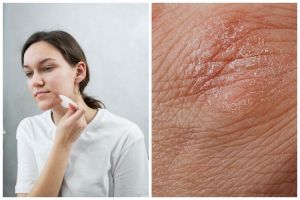 [KUIS] Alami kulit kering dan gatal? Bisa jadi skin barrier kamu rusak, cek lengkapnya di sini yuk