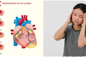 Atasi sebelum terlambat, ini 6 Cara mengenali gejala awal penyempitan pembuluh darah