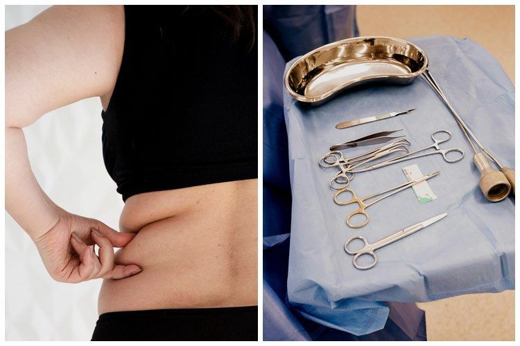 [KUIS] Sedot lemak makan korban? nilai berapa level urgensi kamu buat lakukan liposuction