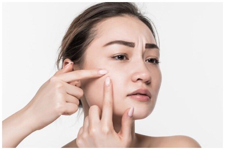 [KUIS] Ketahui cara tepat memilih acne patch sesuai jenis jerawatmu biar nggak salah beli