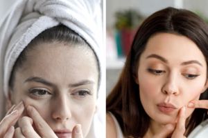 Bisakah hilangkan milia di wajah hanya pakai skincare? Ini penjelasan lengkap dengan langkahnya