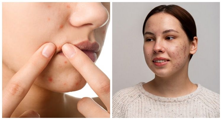 7 Ciri-ciri jerawat karena tidak cocok skincare dan cara mengatasinya auto kulit tenang kembali