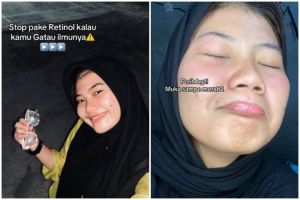 Perjuangan cewek berwajah iritasi dan mengelupas akibat salah pakai retinol bikin takjub, ini triknya
