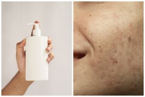 Viral di TikTok pakai sampo antiketombe untuk atasi fungal acne, simak penjelasan agar tak asal pakai