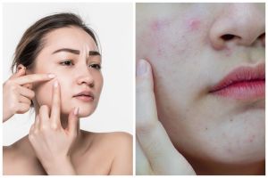 Sering dihindari kulit sensitif, kenali apa itu polyacrylamide dalam skincare