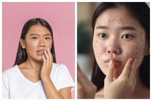 9 Rekomendasi skincare Cetaphil untuk kulit berminyak dan berjerawat harga dibawah Rp 200 ribu