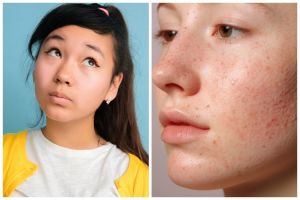 9 Perbedaan azelaic acid skincare dan benzoyl peroxide, mana yang paling ampuh atasi jerawat?