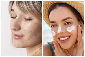 Kulit berjerawat seharusnya pakai sunscreen SPF berapa? Simak penjelasannya biar wajah nggak break out