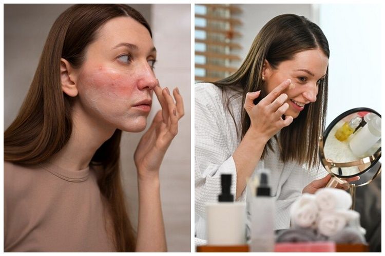 Wajah alami alergi skincare? Simak 9 cara mengatasinya cuma pakai bahan alami