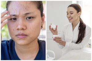 Viral di TikTok untuk atasi jerawat, simak 7 fakta apa itu cream tretinoin