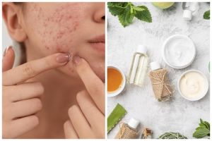 Tak pakai acne patch, ini trik menghilangkan jerawat membandel pada wajah cuma pakai 1 jenis bunga