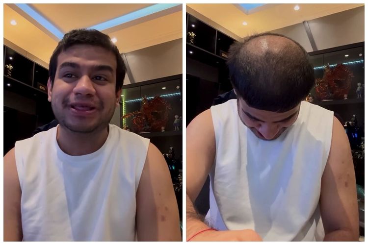 [KUIS] Fadil Jaidi pamer rambut botak: begini cara mengatasinya dan temukan metode yang tepat