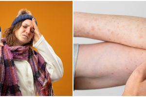 Terkonfirmasi 8 kasus cacar monyet terjadi di Indonesia, kenali gejala dan cara pencegahannya