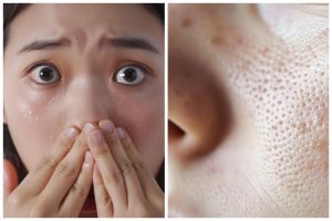 7 Kandungan dan rekomendasi skincare untuk komedo putih, auto bikin wajah jadi bersih