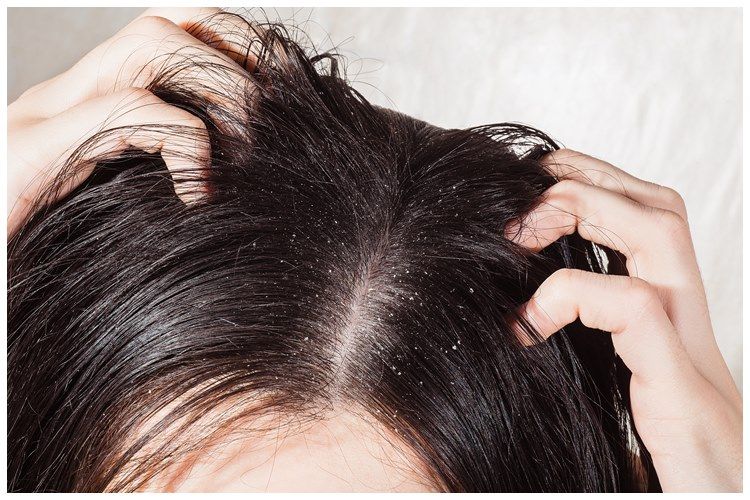 [KUIS] Apa perbedaan ketombe kering vs basah? Cari tahu lewat 5 tes singkat dan temukan solusinya