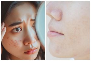  Tanpa krim pemutih, ini cara hilangkan dark spot hanya pakai minuman dari 4 jenis buah