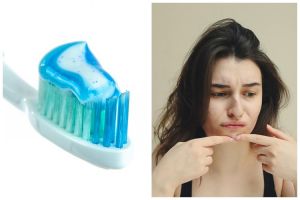 [KUIS] Benar atau salah: pasta gigi dapat mengobati jerawat? Cek faktanya lewat pertanyaan ini