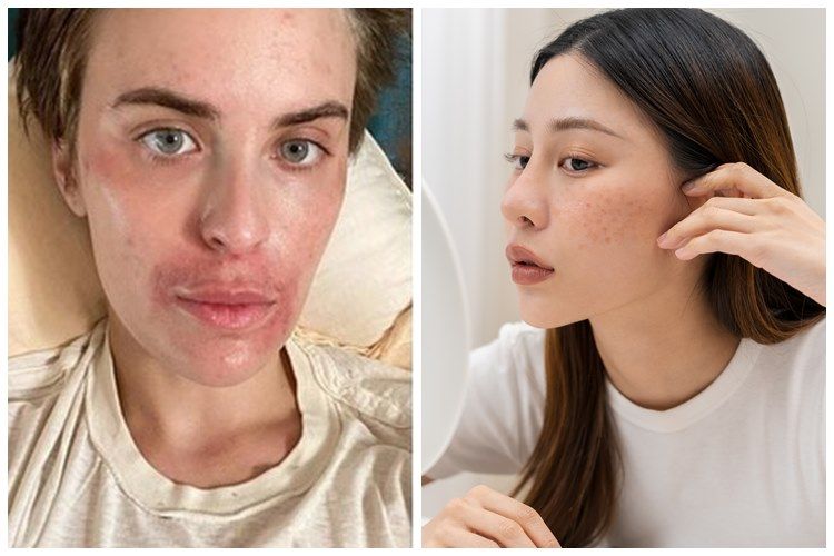 [KUIS] Apa itu skin picking disorder yang diderita anak Demi Moore? Tes pengetahunmu di sini