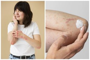 Apa itu keratosis pilaris? Kenali dan simak penjelasannya menurut dermatolog
