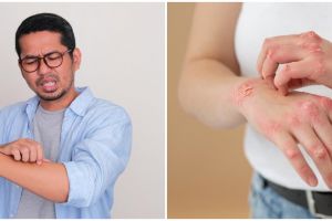 Cacar monyet jadi ancaman kesehatan, kenali 5 perbedaannya dengan cacar air