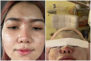Bukti beauty is pain, cewek ini bagikan perubahan wajahnya sebelum dan usai treatment facial peeling