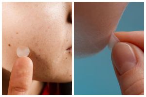 Pakai acne patch sebelum atau sesudah skincare? Ini fakta lengkapnya agar tak salah langkah