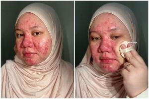 Bukti keajaiban makeup, transformasi cewek wajah kemerahan penuh jerawat ini hasilnya auto mulus