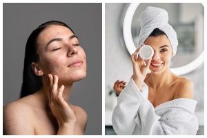 9 Cara menghilangkan jerawat tanpa skincare, andalkan bahan alami ini untuk kulit halus