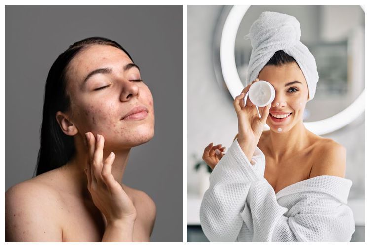 9 Cara menghilangkan jerawat tanpa skincare, andalkan bahan alami ini untuk kulit halus