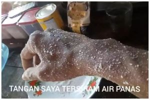 Cara mengatasi kulit terkena air panas agar tidak melepuh dan berbekas pakai bumbu dapur